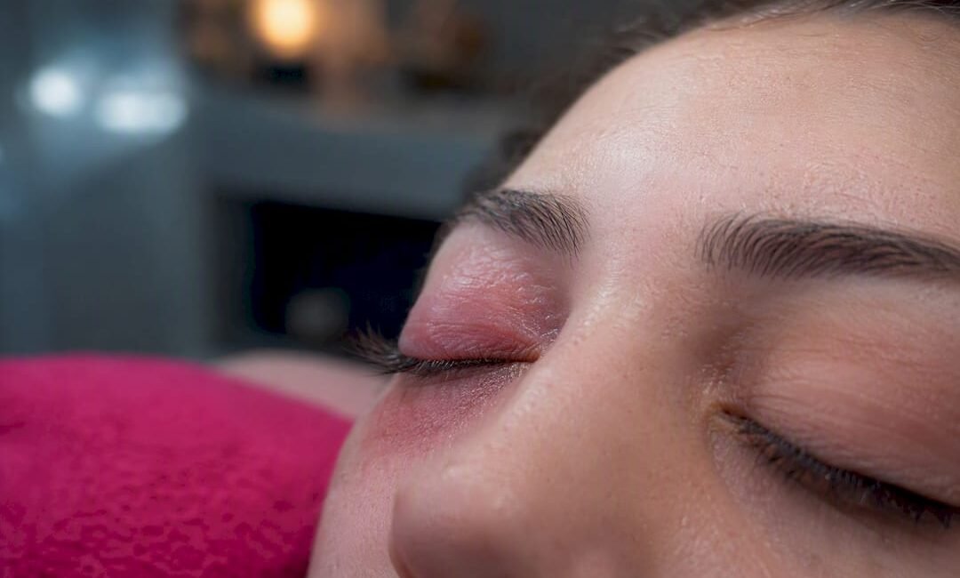Palpebra gonfia a causa di una reazione alla colla